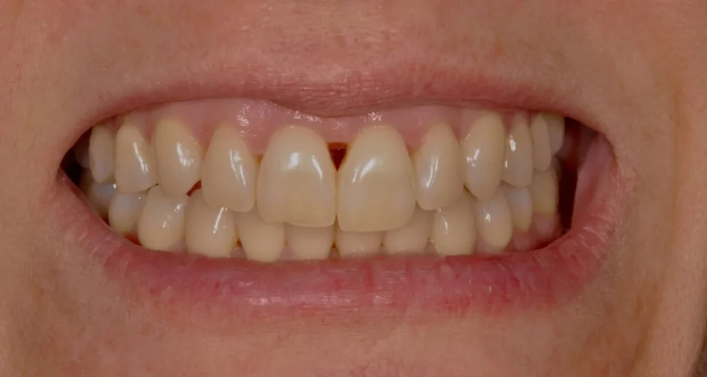¿Pueden los espacios entre los dientes (diastema) cerrarse naturalmente
