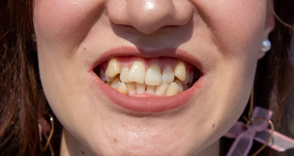 ¿Qué Es El Apiñamiento Dental