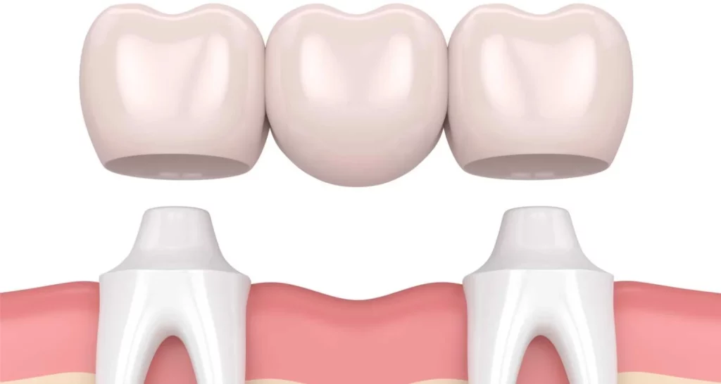 ¿Qué son los puentes dentales