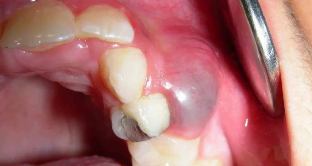Tratamiento Del Quiste De Erupción Dental