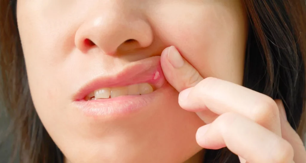What Causes Canker Sores