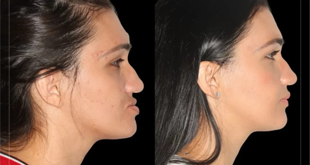 What is orthognathic surgery