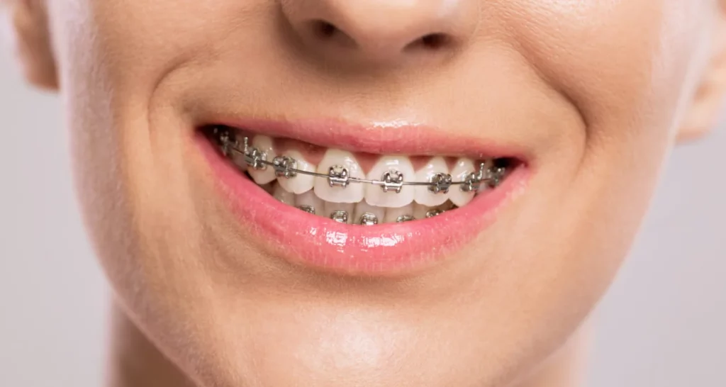 ¿Cuál Es El Tratamiento Para el Espacios Entre Los Dientes (Diastema)