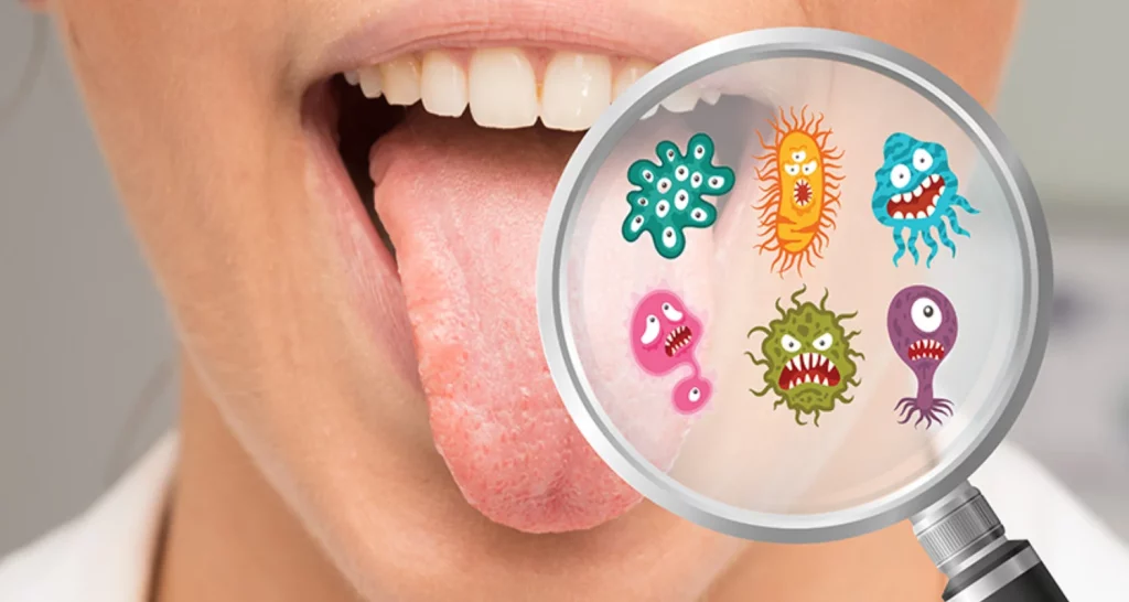 ¿Qué Bacterias Causan Enfermedad Periodontal