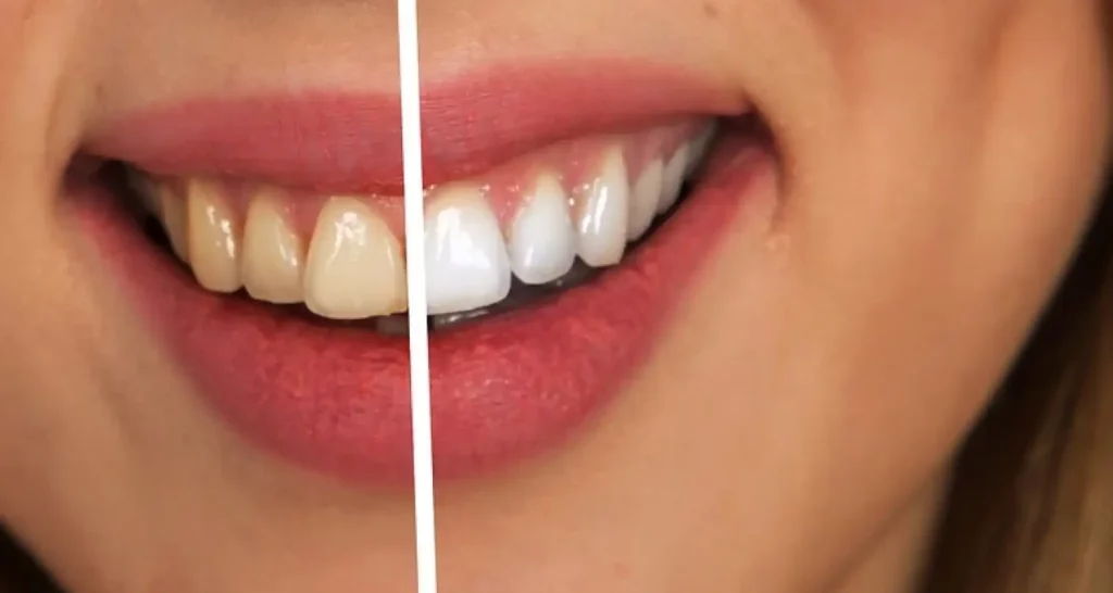 ¿Sabes Cómo Funciona Y Si Es Seguro Blanquear Los Dientes