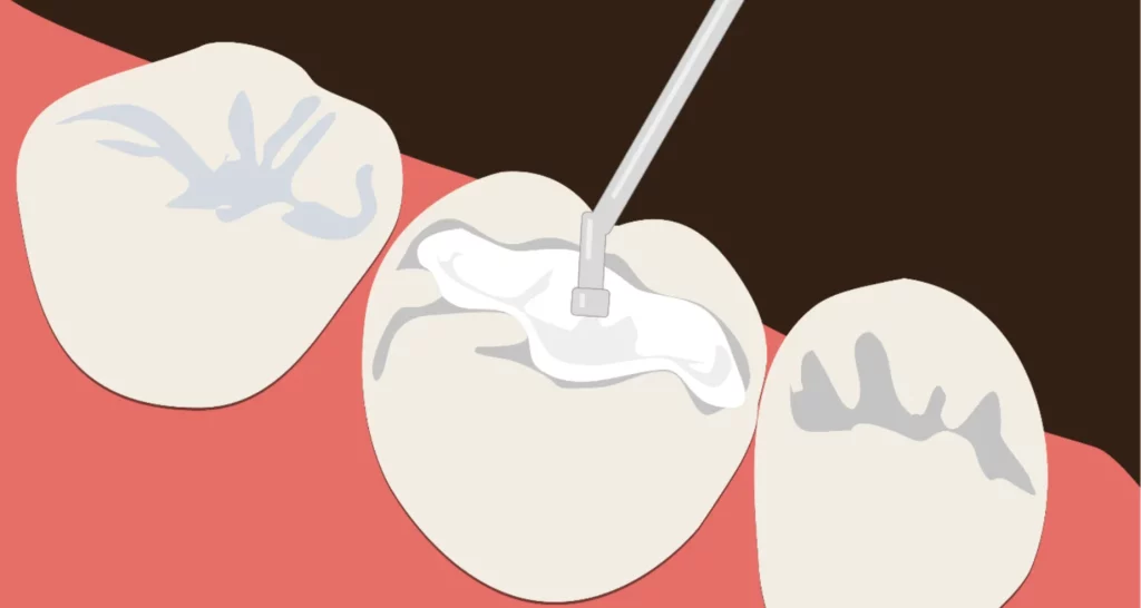 ¿Qué es un empaste dental temporal