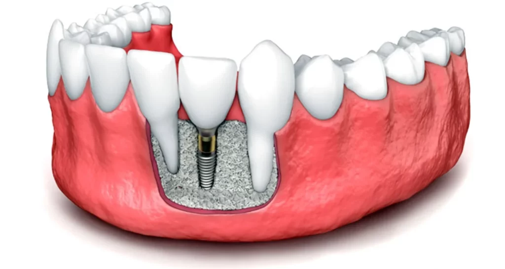 5 uses of dental bone grafts