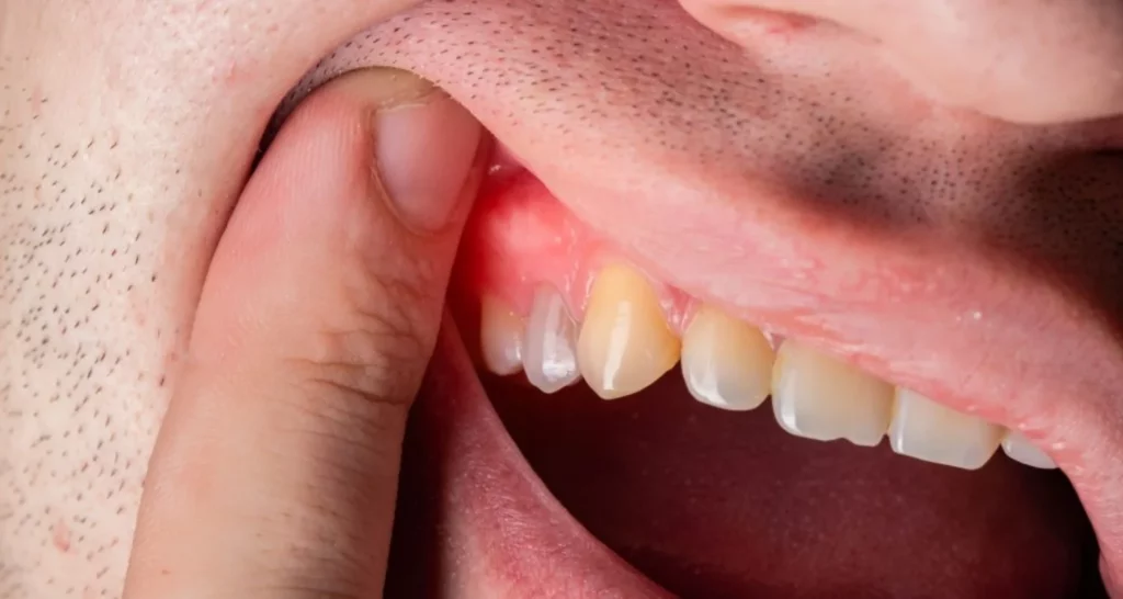 DIY Remedies For Gum Inflammation