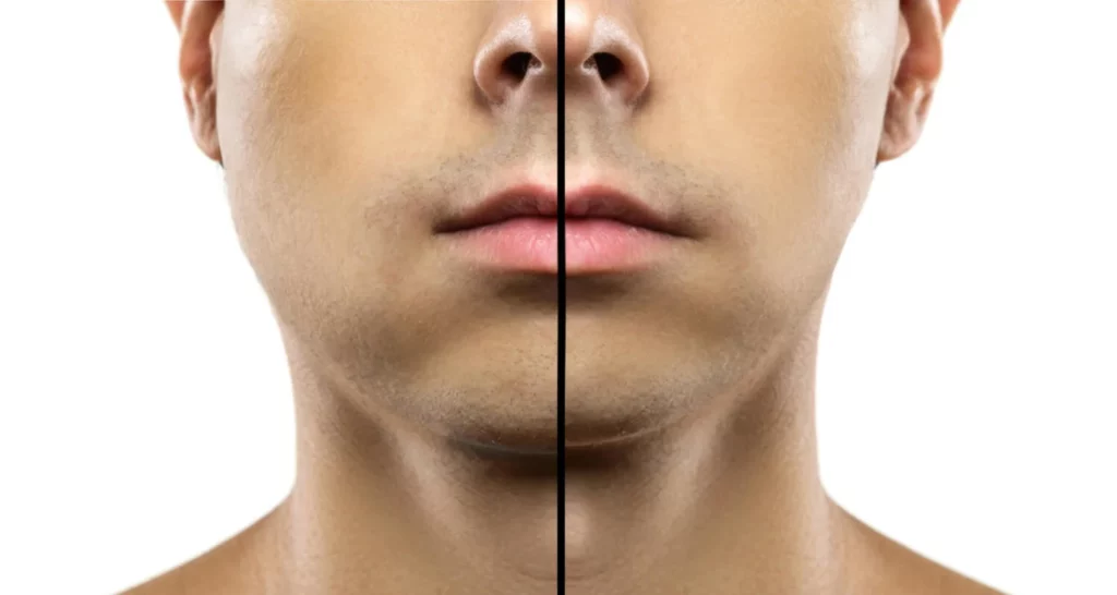 How can you recognize the symptoms of jaw bone cavitation
