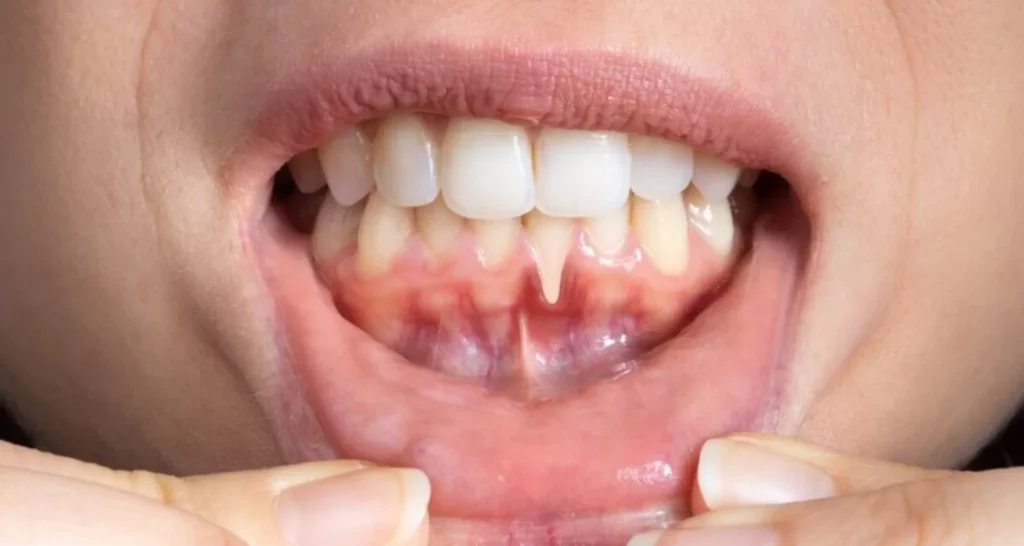 How to Cure Receding Gums 