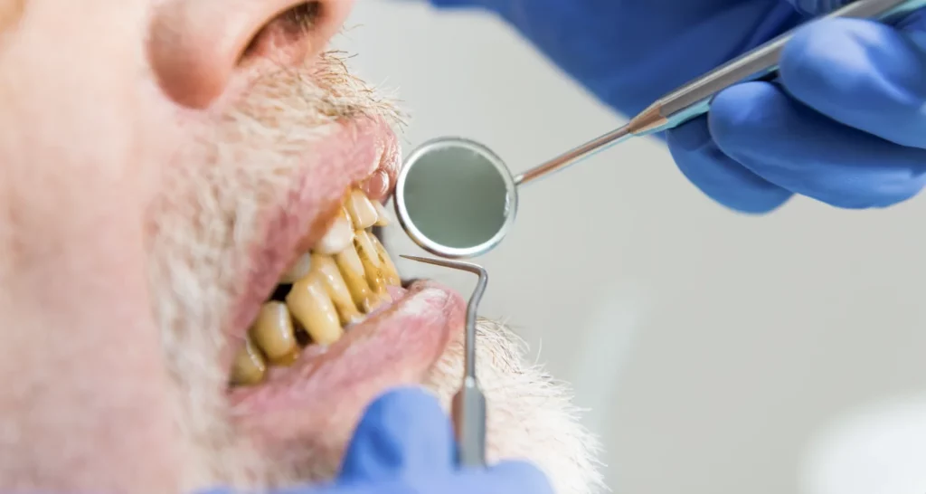 Risks of Poor Oral Hygiene