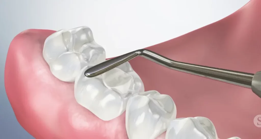 What is a temporary dental filling made of