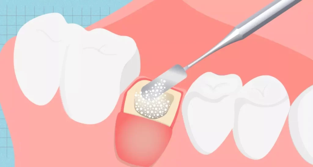 What is the dental bone graft procedure
