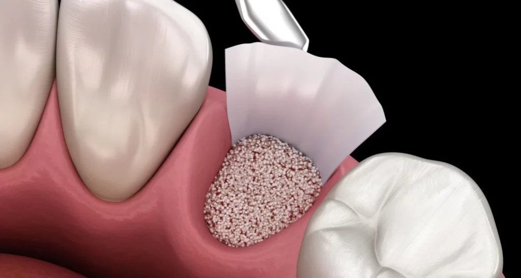 What material is used in a dental bone graft