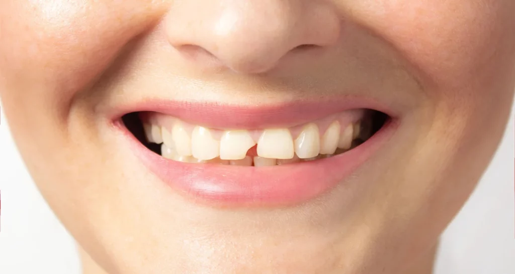 What to do to Chipped Front Teeth Repair