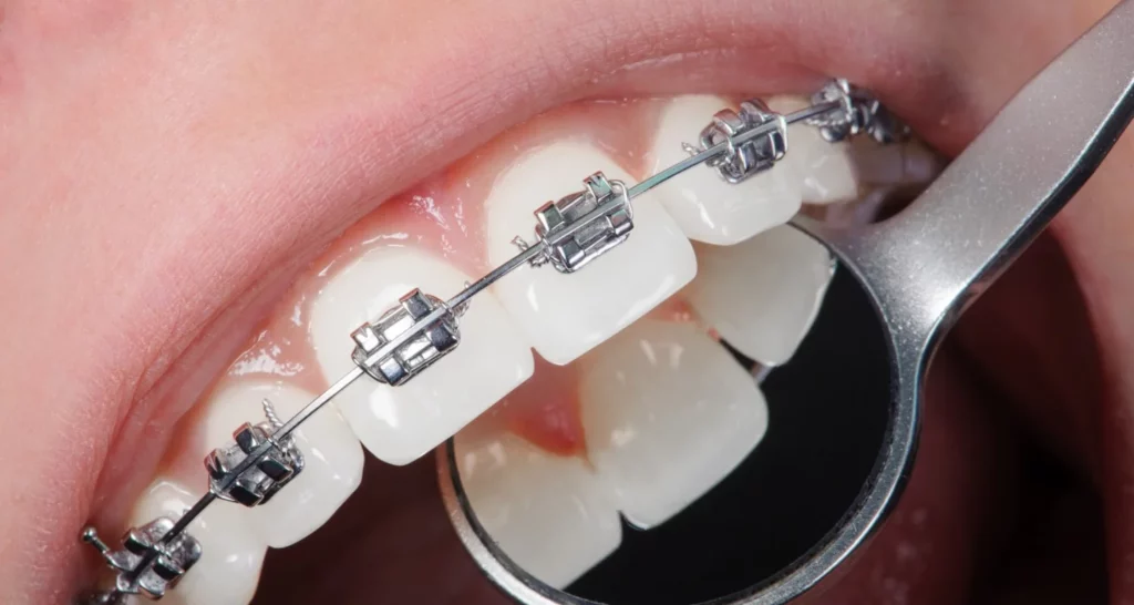 Why does dental resorption occur