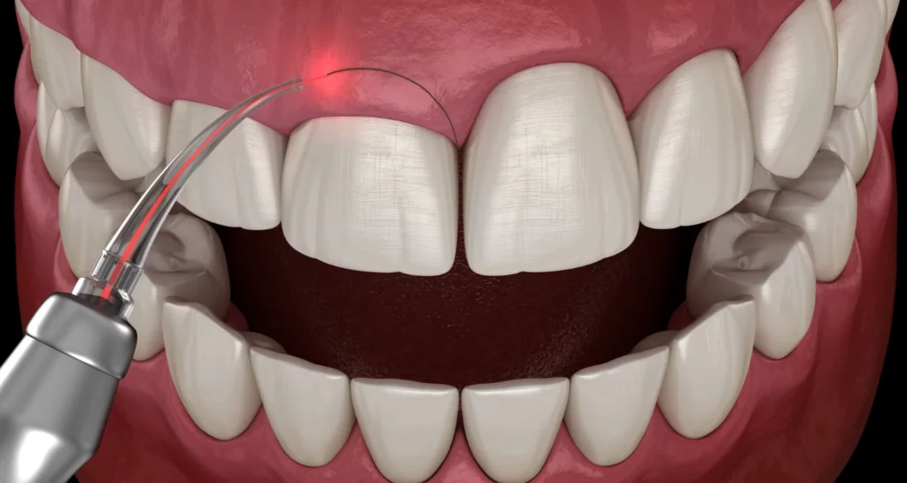 ¿Cómo se realiza Gingivectomía