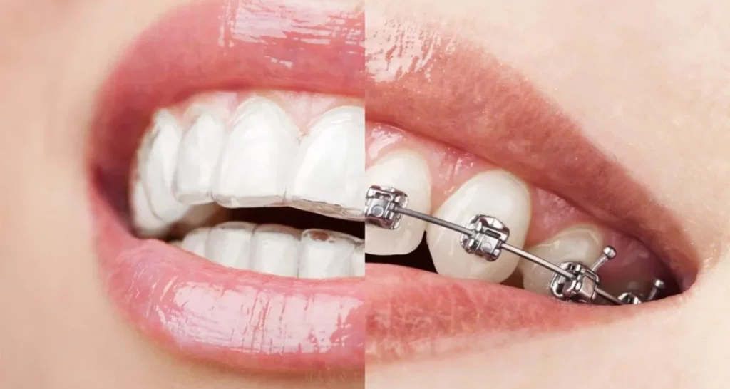 ¿Invisalign o brackets para maloclusión clase II__ Factores a considerar