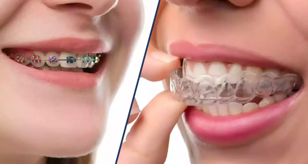 Brackets v_s Invisalign_ a comparison