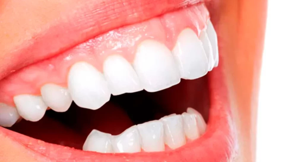 Conoce todo sobre la gingivectomía