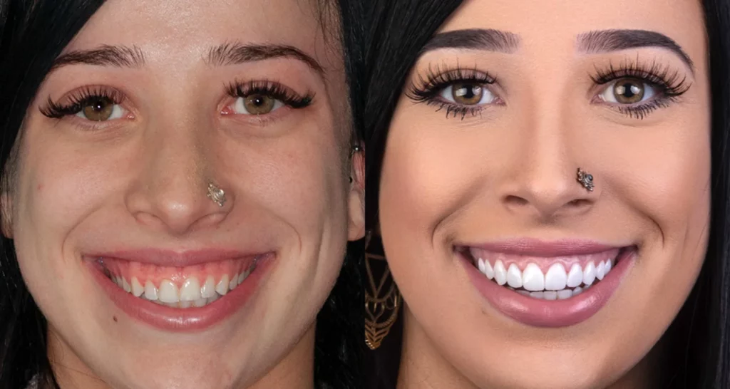 Discover Gum Contouring Risks and How to Avoid Them