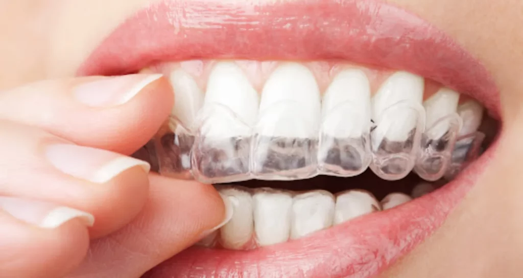 Tratamiento con alineadores invisibles_ Invisalign