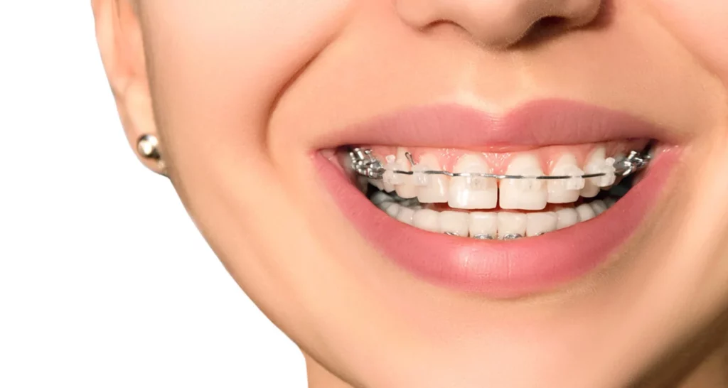 Maloclusión Clase 2: ¿Qué Opción Usar Invisalign o Brackets?