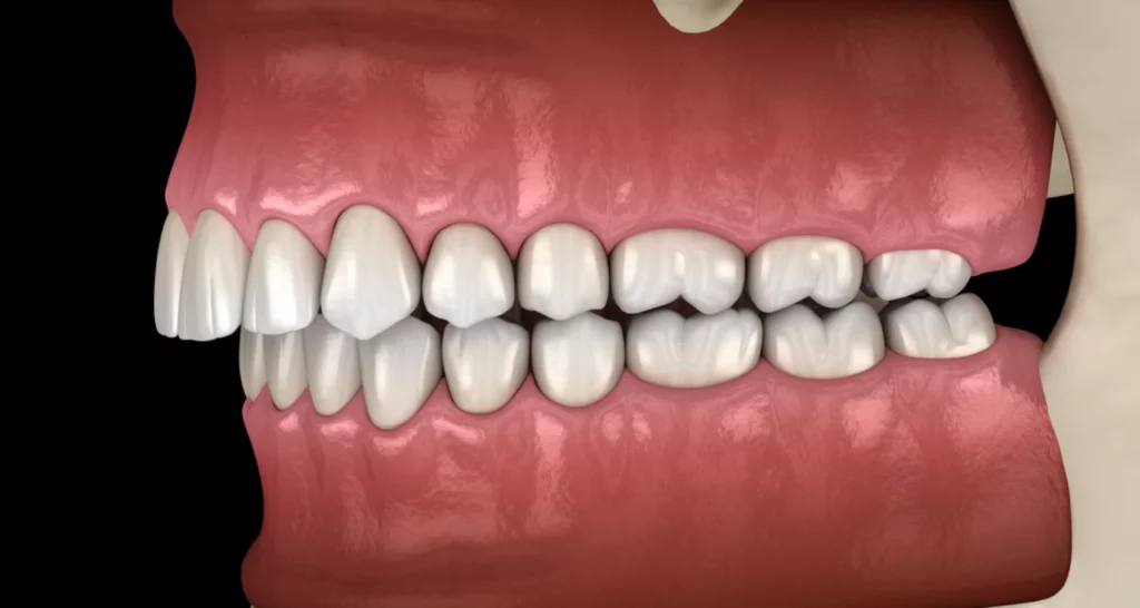 What is malocclusion