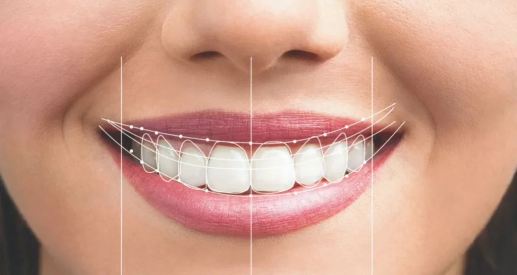 1 - Is teeth reshaping good for you_ The experts said this!