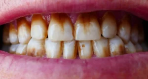 1- Say Goodbye to Coffee Stains on Teeth with These Tips