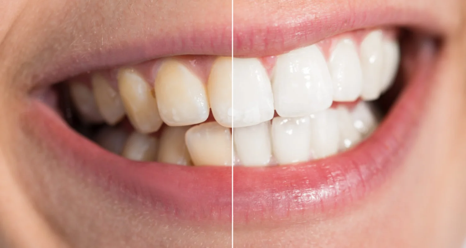 2 - What is teeth reshaping