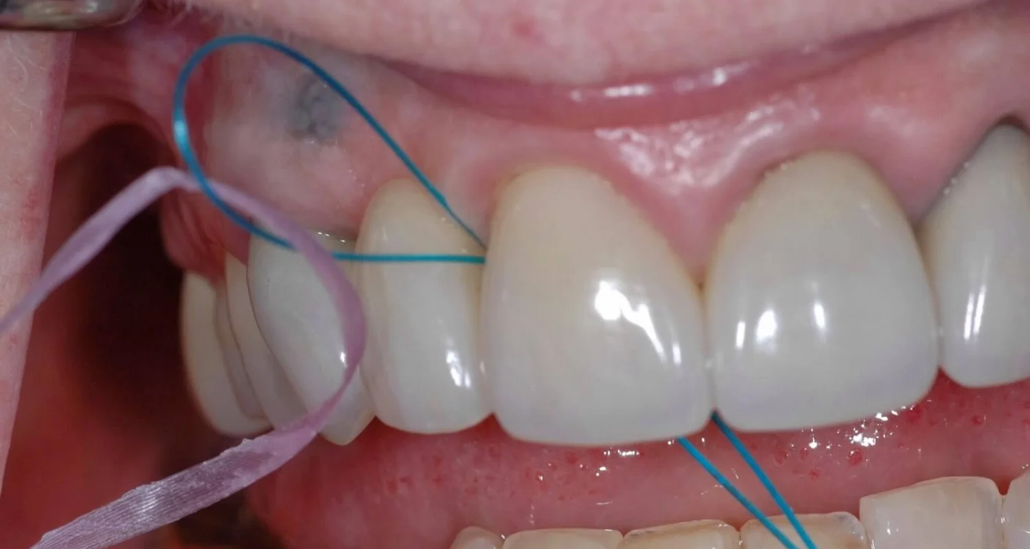 4 - Floss threader - dental floss with braces