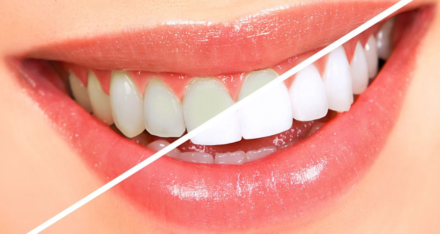  teeth whitening - Smile Makeover Treatment