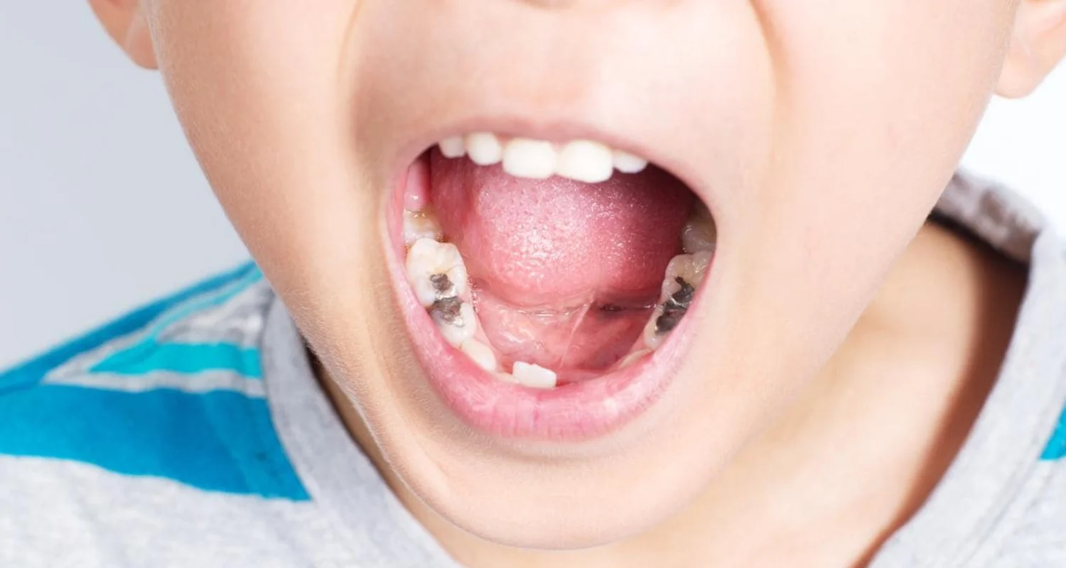 2 - ¿Qué es la caries infantil