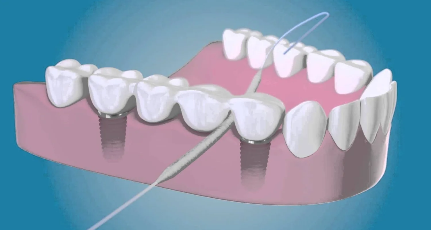 4 - Superfloss - usar hilo dental con brackets