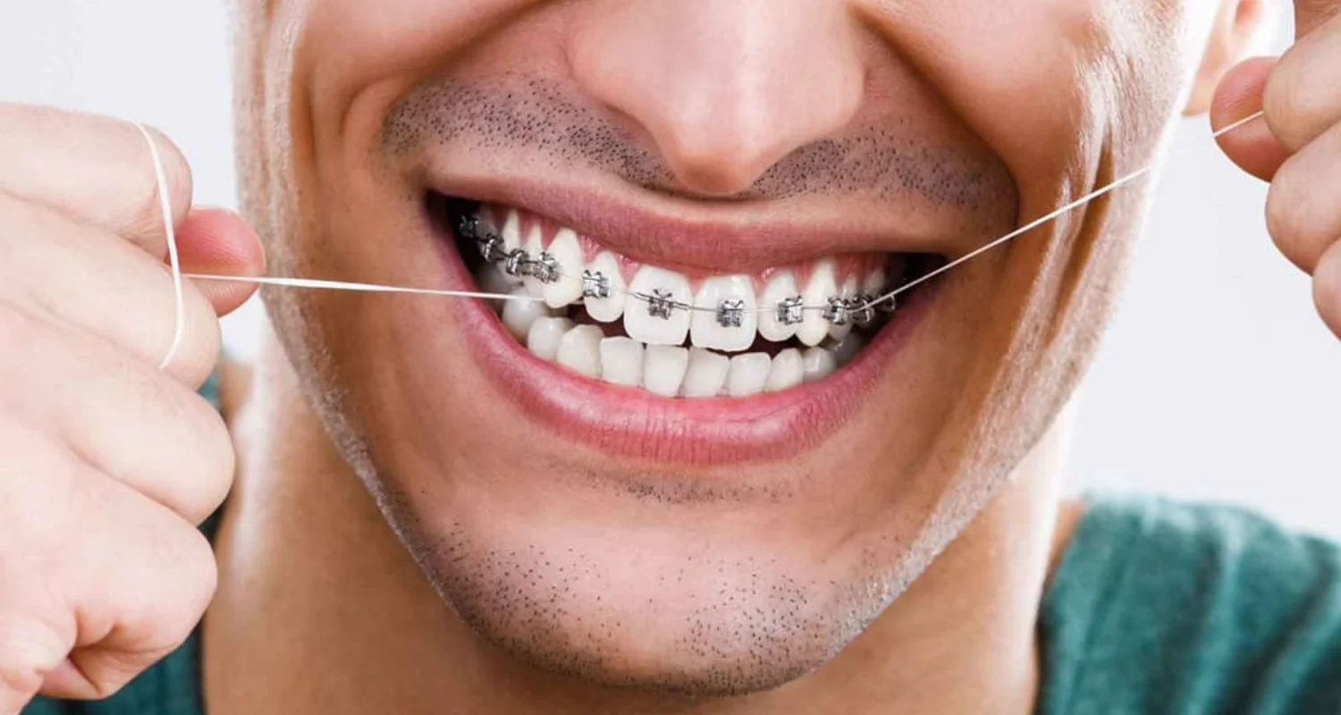 5 - Usar hilo dental con brackets_ trucos y consejos generales