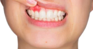 1 - 5 remedios caseros para la gingivitis y la salud bucal