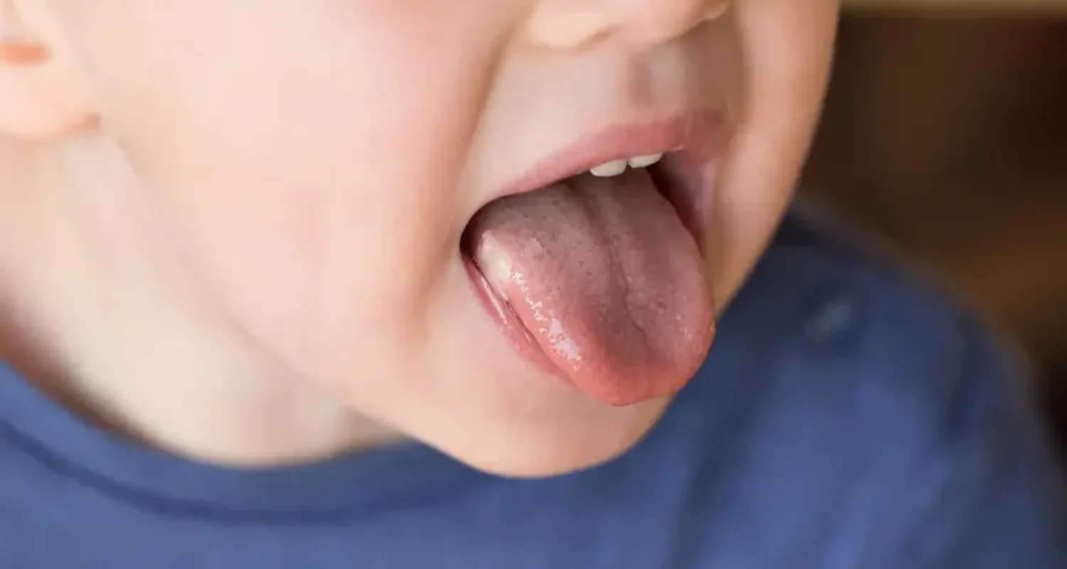 2 - ¿Por qué aparece la halitosis infantil o mal aliento en los niños