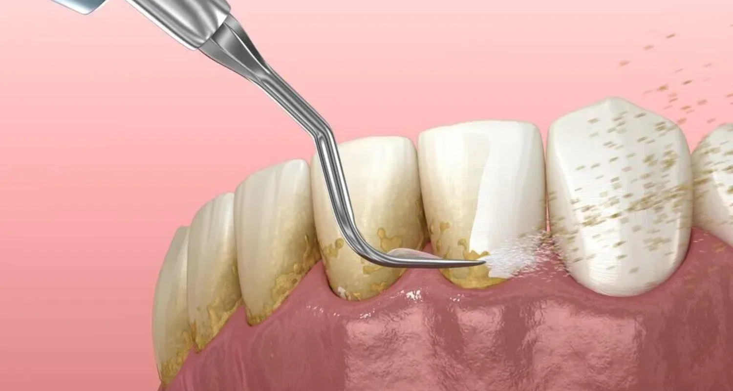 2 - What is and how to remove dental plaque