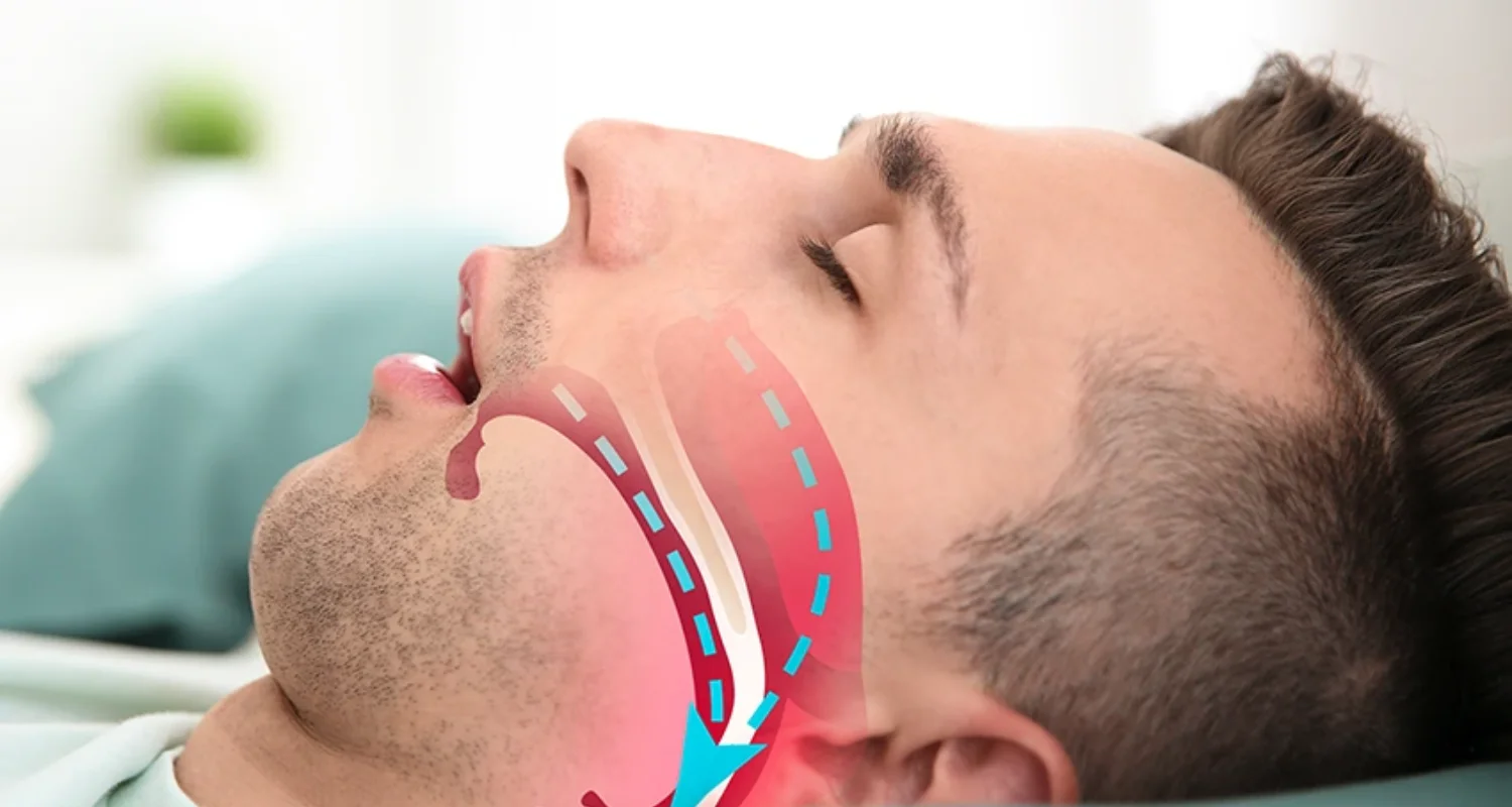 2 - What is the relationship between sleep apnea and oral health