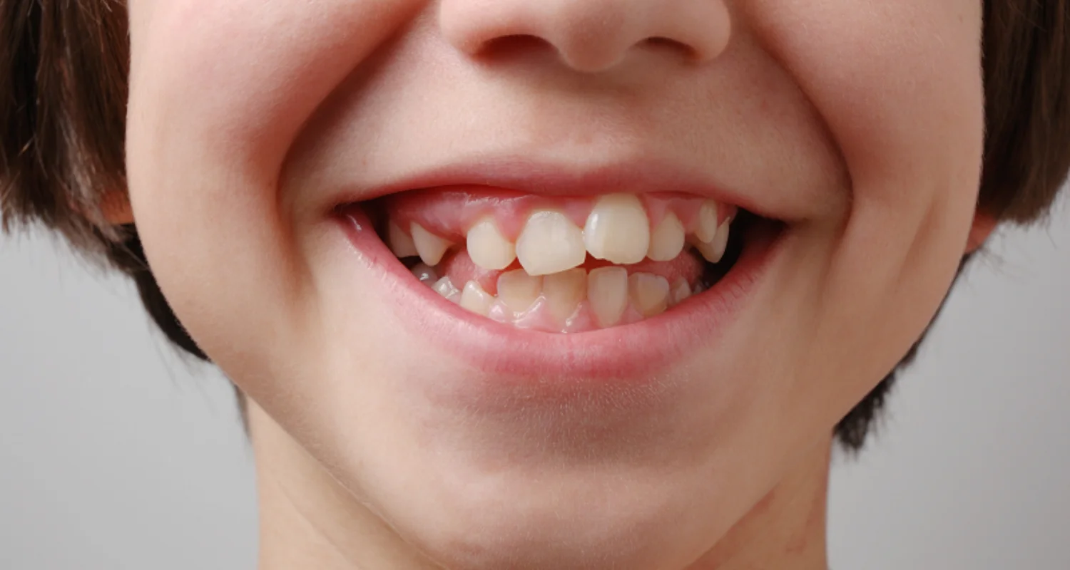 3 - Maloclusiones dentales por chuparse el dedo