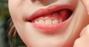 1 - Best Practices for Pericoronitis Treatment at Home