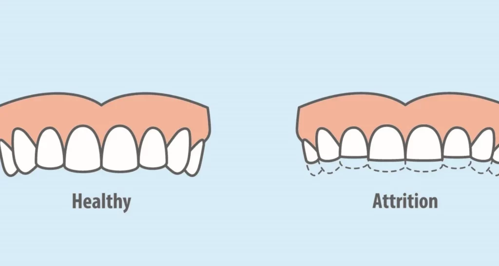 1 - Dental Attrition Explained_ Causes, Risks, and Fixes