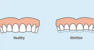 1 - Dental Attrition Explained_ Causes, Risks, and Fixes