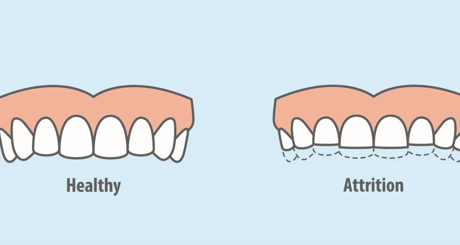 1 - Dental Attrition Explained_ Causes, Risks, and Fixes