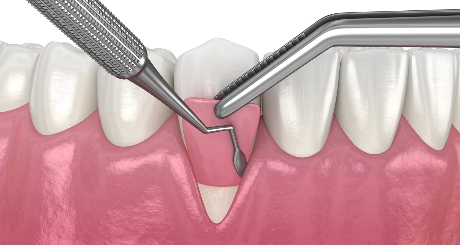 1 - Gum Graft Surgery Explained_ Benefits and Risks