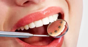 1 - How Lingual Braces Work_ Benefits and Drawbacks