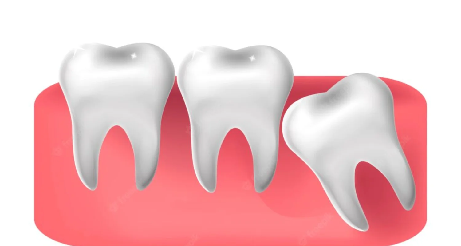 2 - ¿Qué es la pericoronitis_ - remedios caseros para la pericoronitis