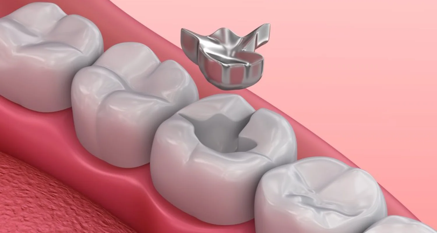 2 - ¿Qué es un empaste dental_ - dolor después del empaste dental