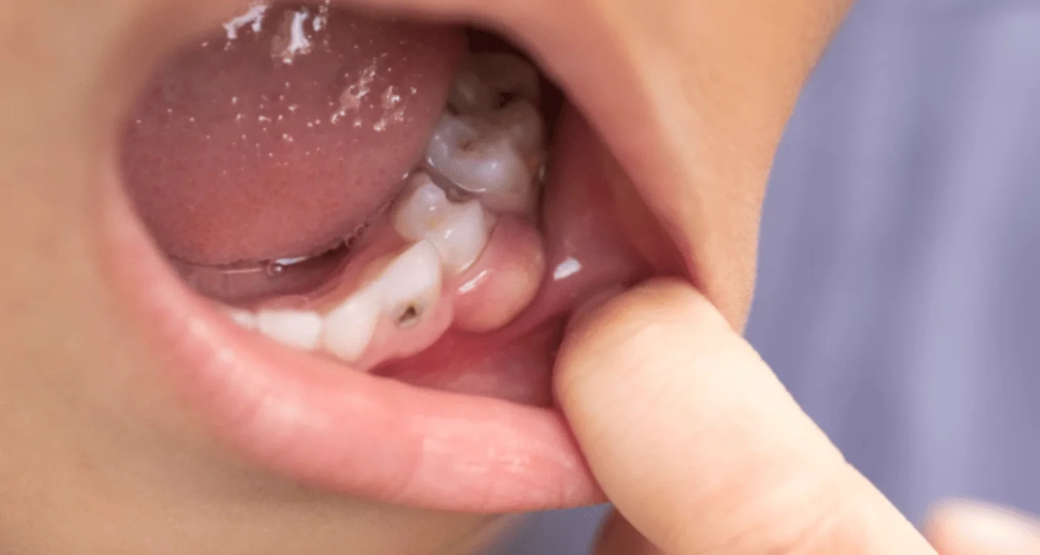 2 - ¿Qué es una infección dental_ - Mejor antibiótico para infección de dientes